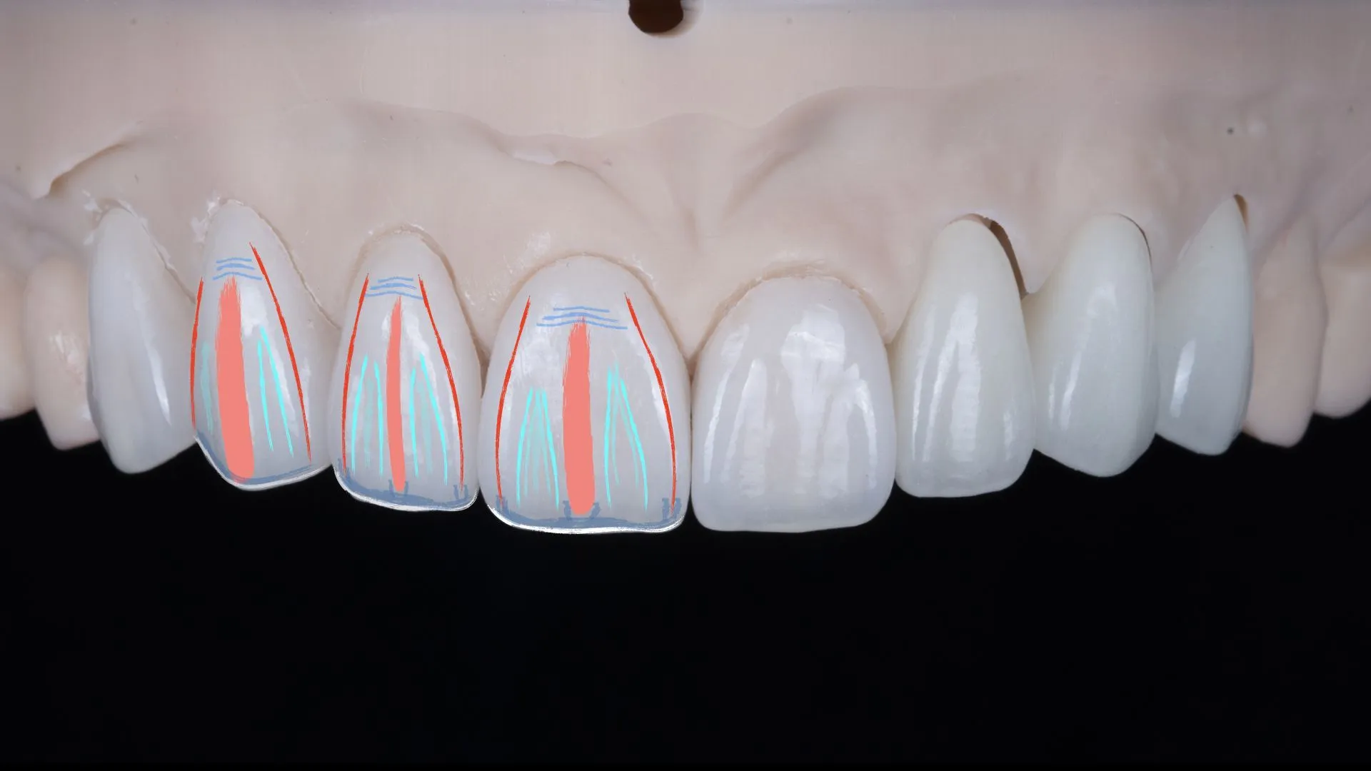 Multilayer build-up — natural shade and form designed for each individual patient