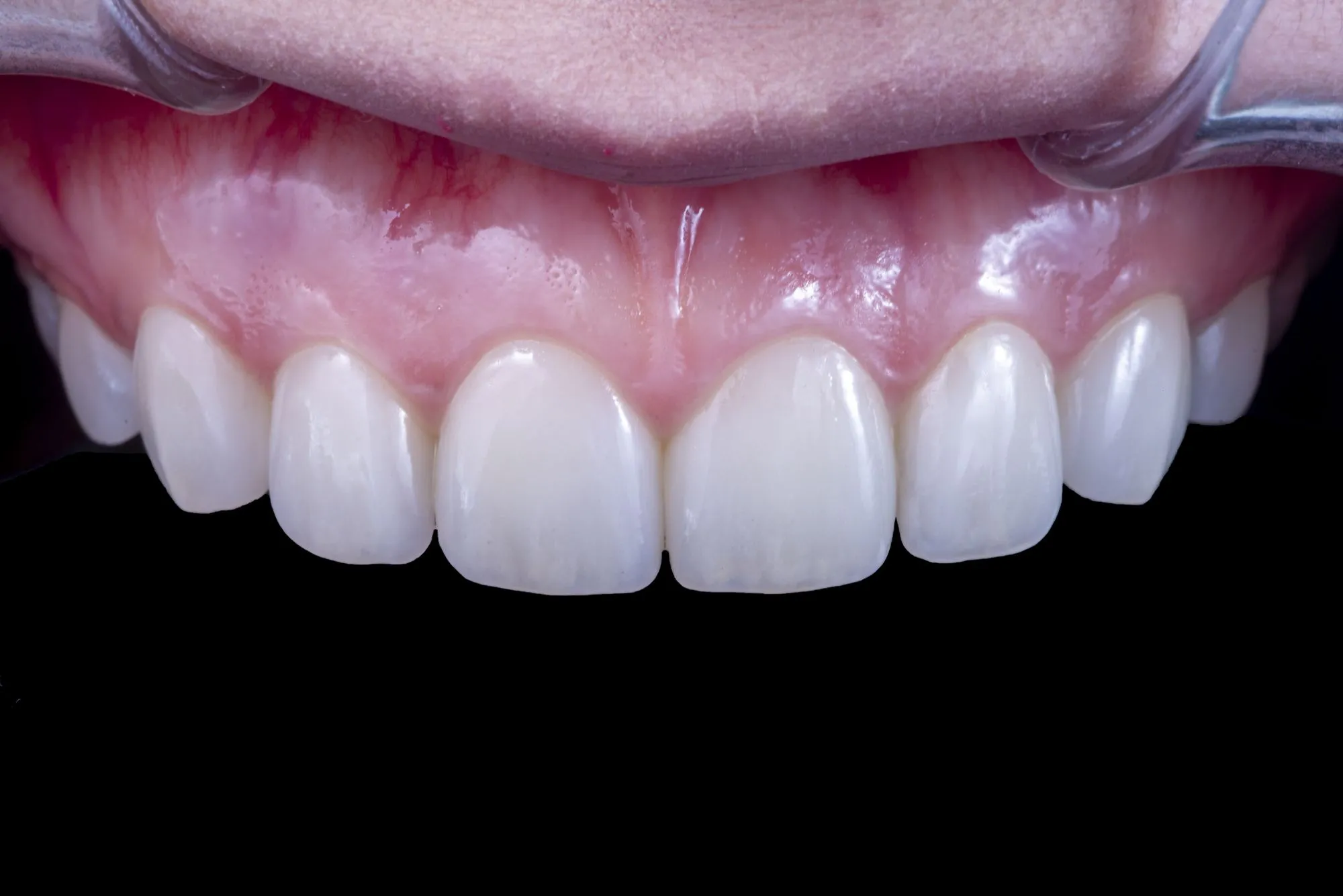 Upper eight anterior teeth, micro-reduction veneers — natural translucency achieved with multilayer build-up; a 20-year clinical case by Dr. Park Jonguk