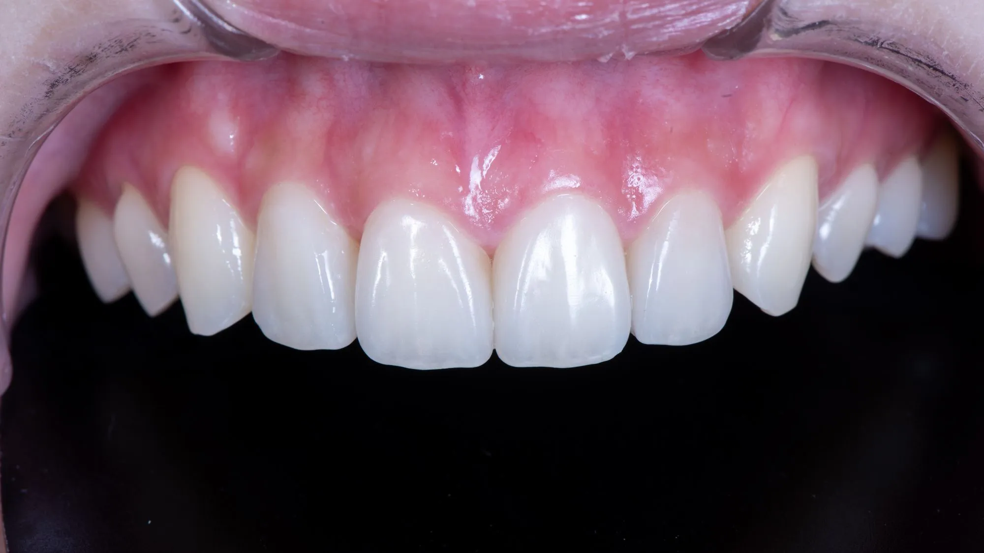 Upper four anterior teeth, micro-reduction veneers — shade reproduced in harmony with the natural dentition; a work of twenty years of clinical practice