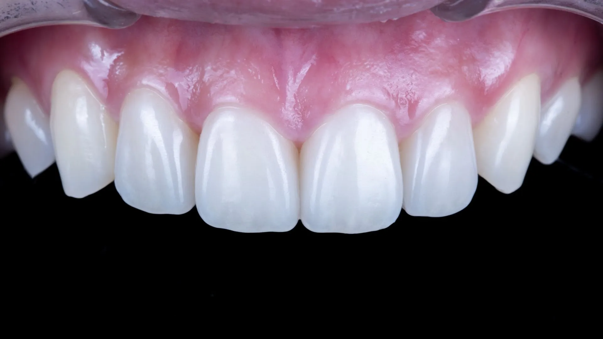 Upper four anterior teeth, micro-reduction veneers — a multilayer build-up case preserving natural tooth structure with minimal reduction