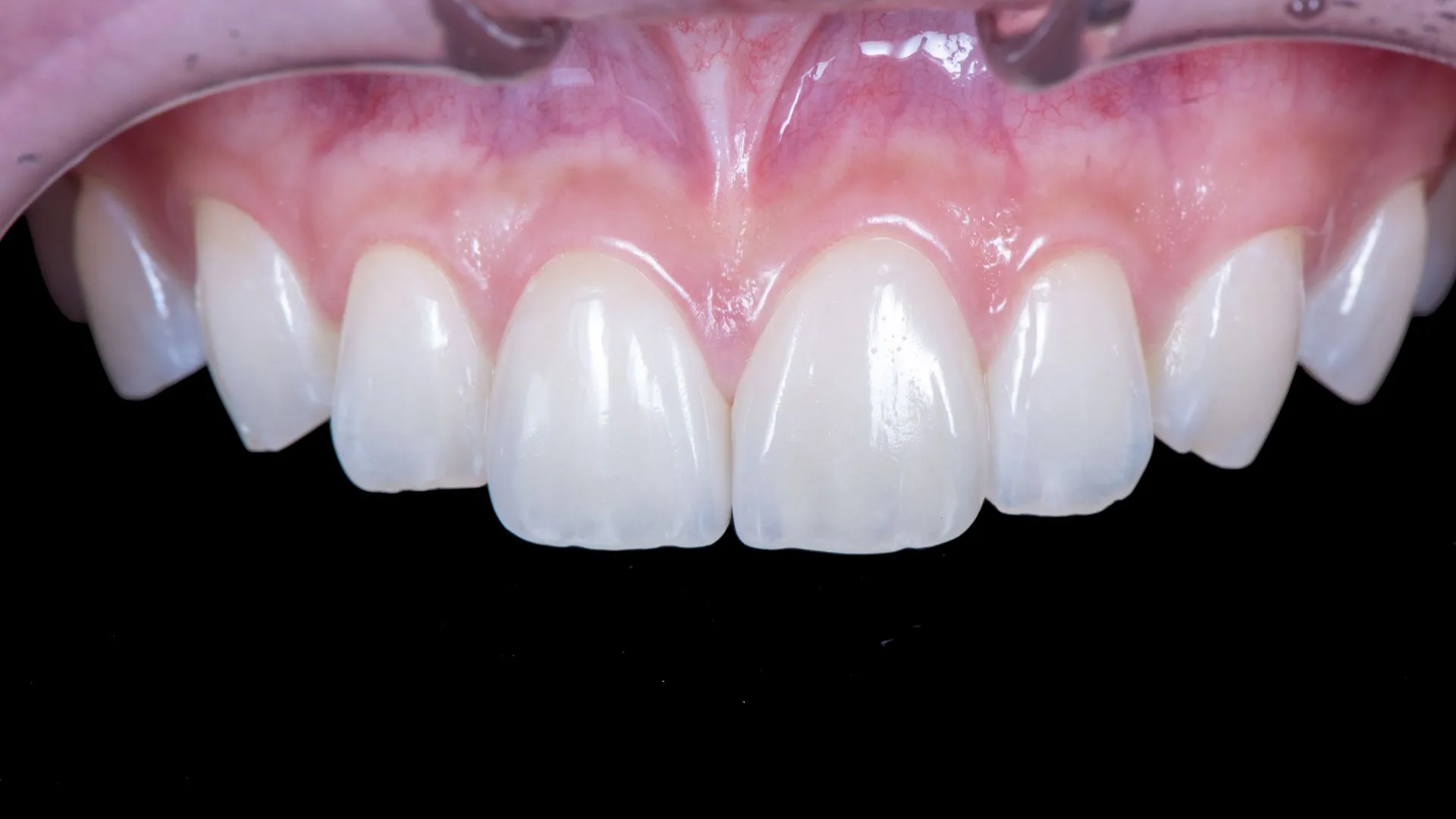 Upper two anterior teeth, no-prep veneers — a case of aesthetic improvement without any tooth reduction