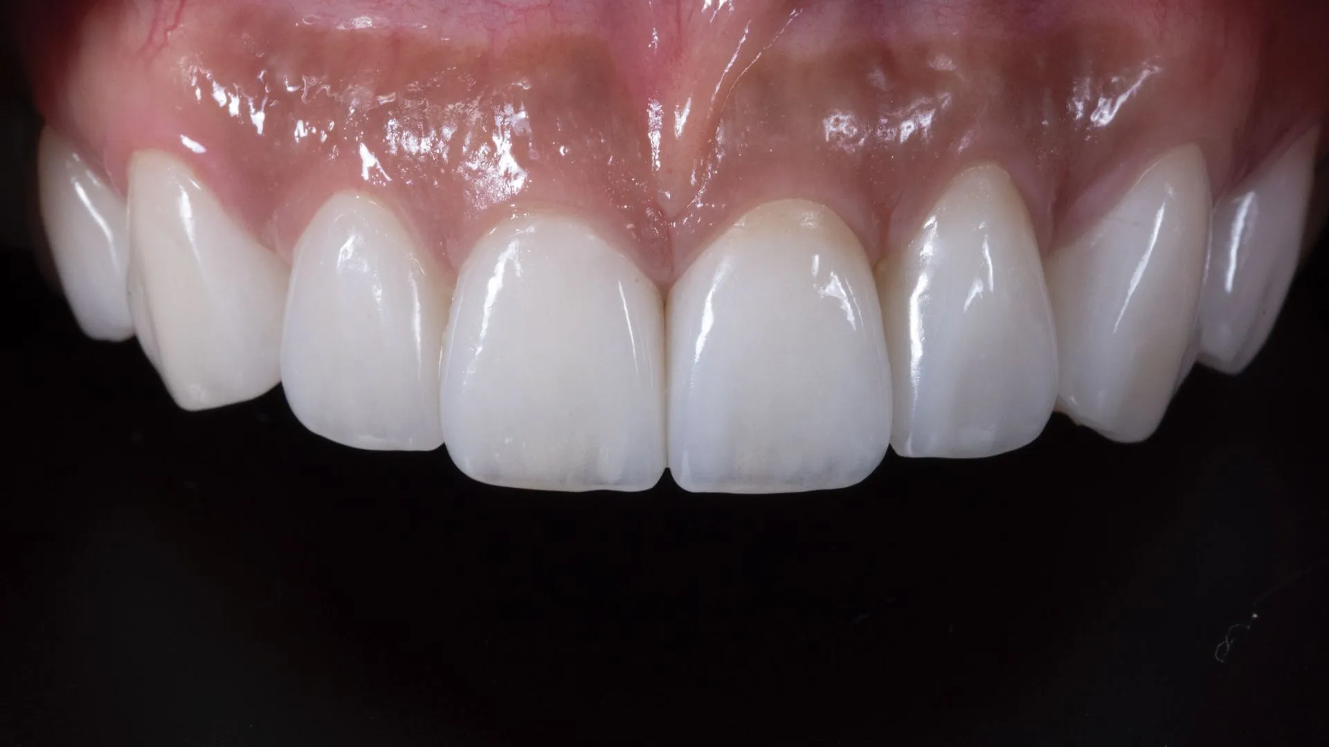 Upper six anterior teeth, micro-reduction veneers — natural translucency and anterior harmony
