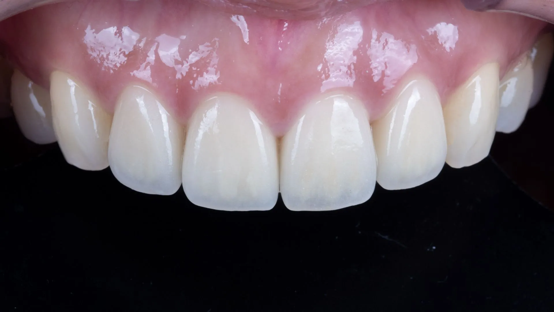 Upper four anterior teeth, crown retreatment — a natural look restored with multilayer build-up veneers