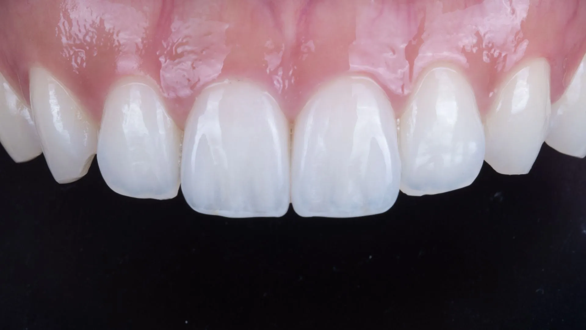 Upper two anterior teeth, veneer retreatment — a natural finish after replacing the previous restorations