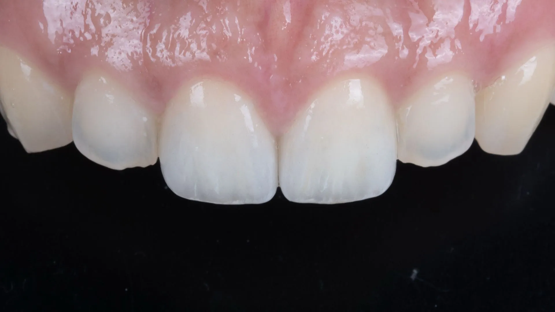 Upper two anterior teeth, veneer retreatment — multilayer build-up revision after Er:YAG laser removal