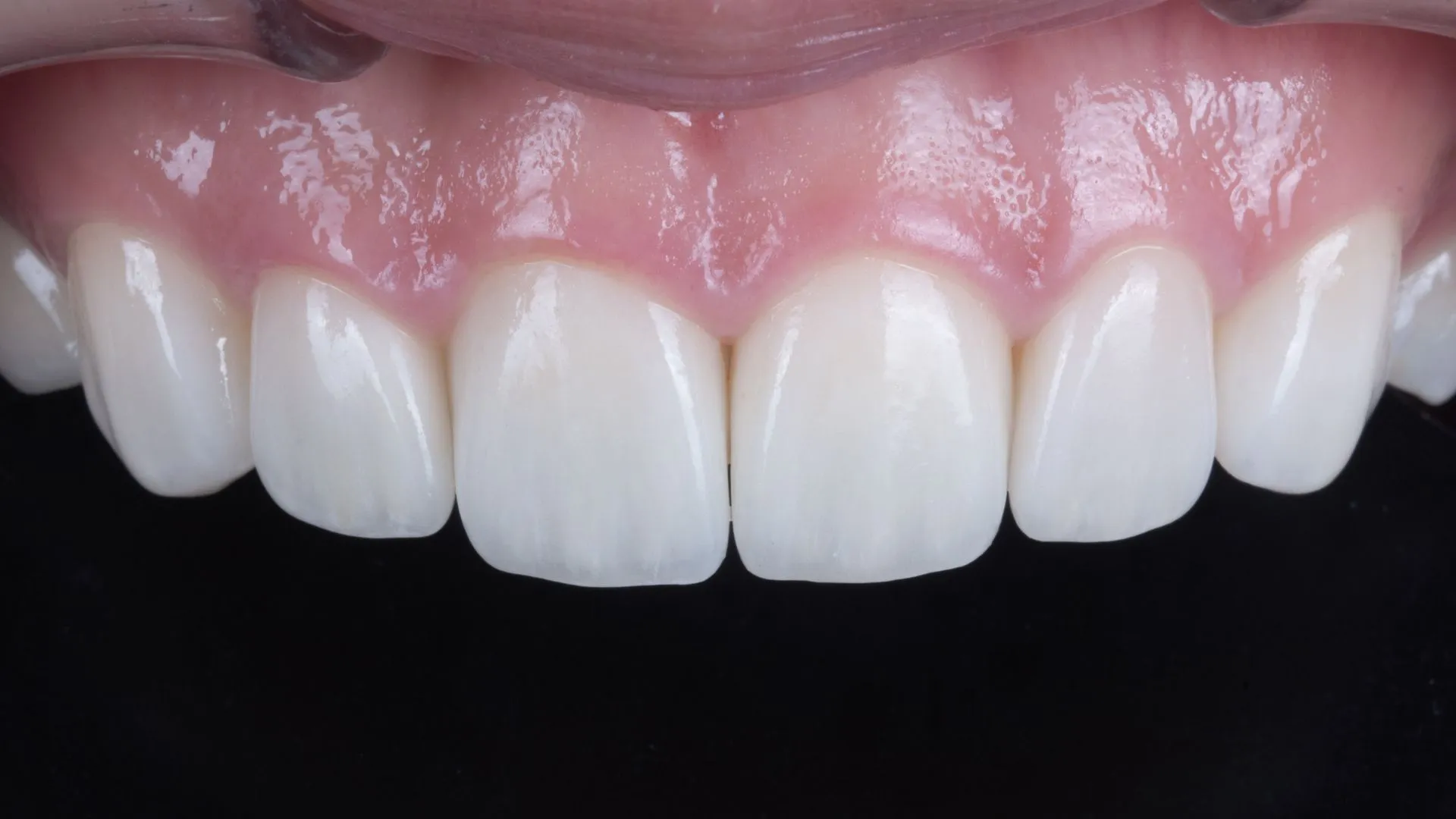 Upper four anterior teeth, micro-reduction veneers — ceramic built up by hand with devoted care