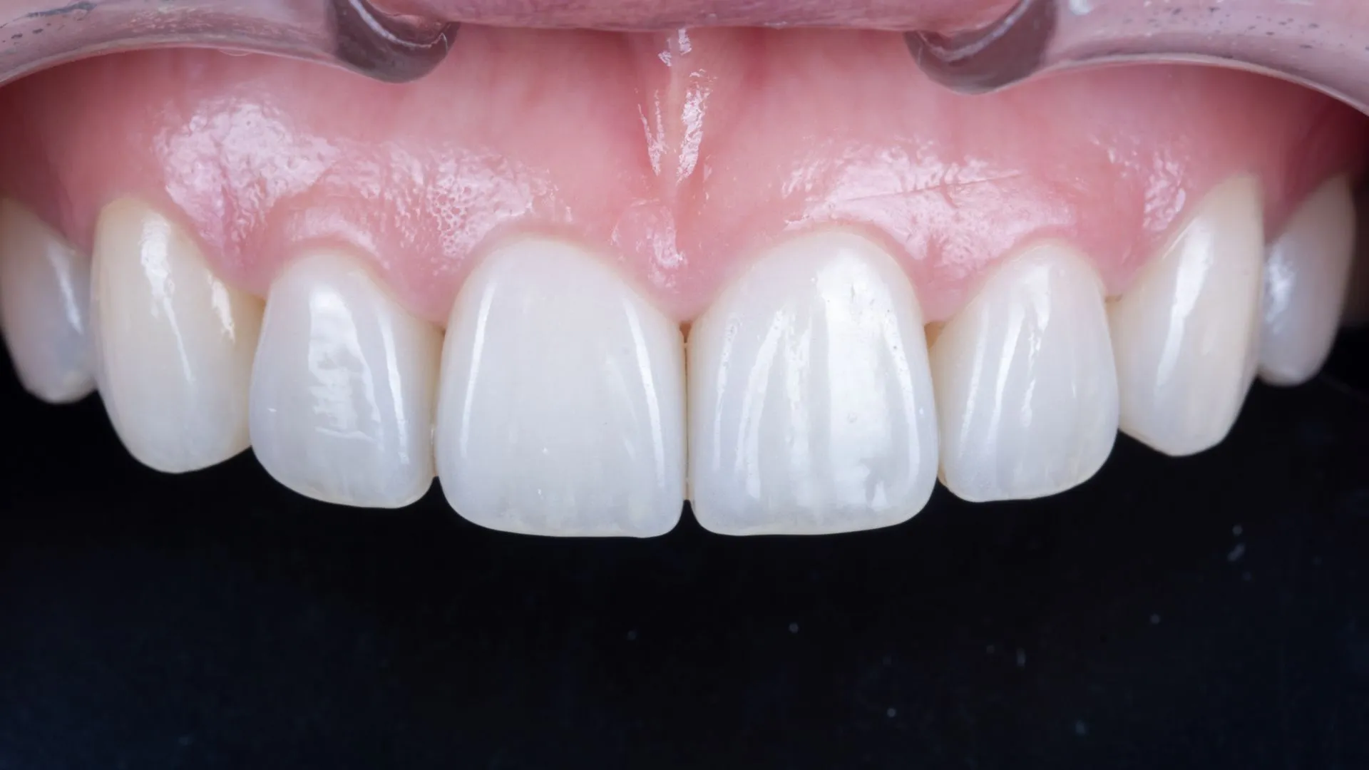 Multilayer build-up veneer clinical case — upper anterior teeth, reproducing the translucency of natural teeth