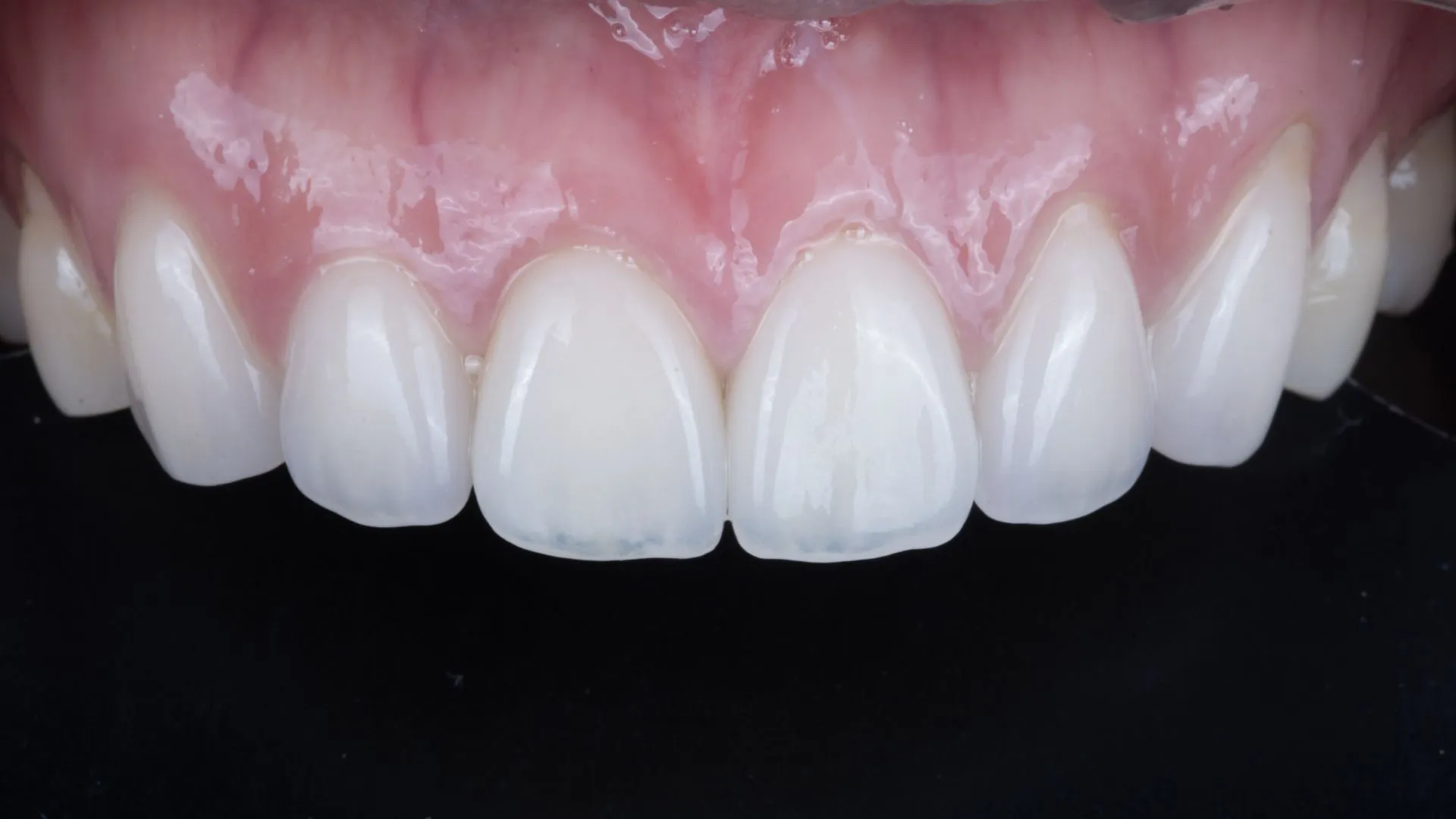 Natural-looking veneer result — hand-layered from four to five ceramic powders