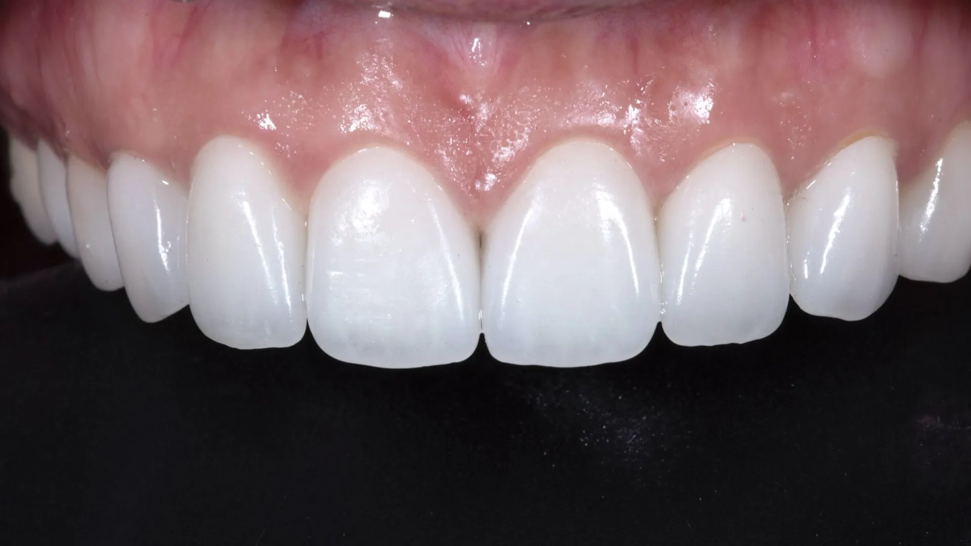 A veneer clinical case by Dr. Park Jonguk — upper anterior aesthetic improvement, minimally invasive