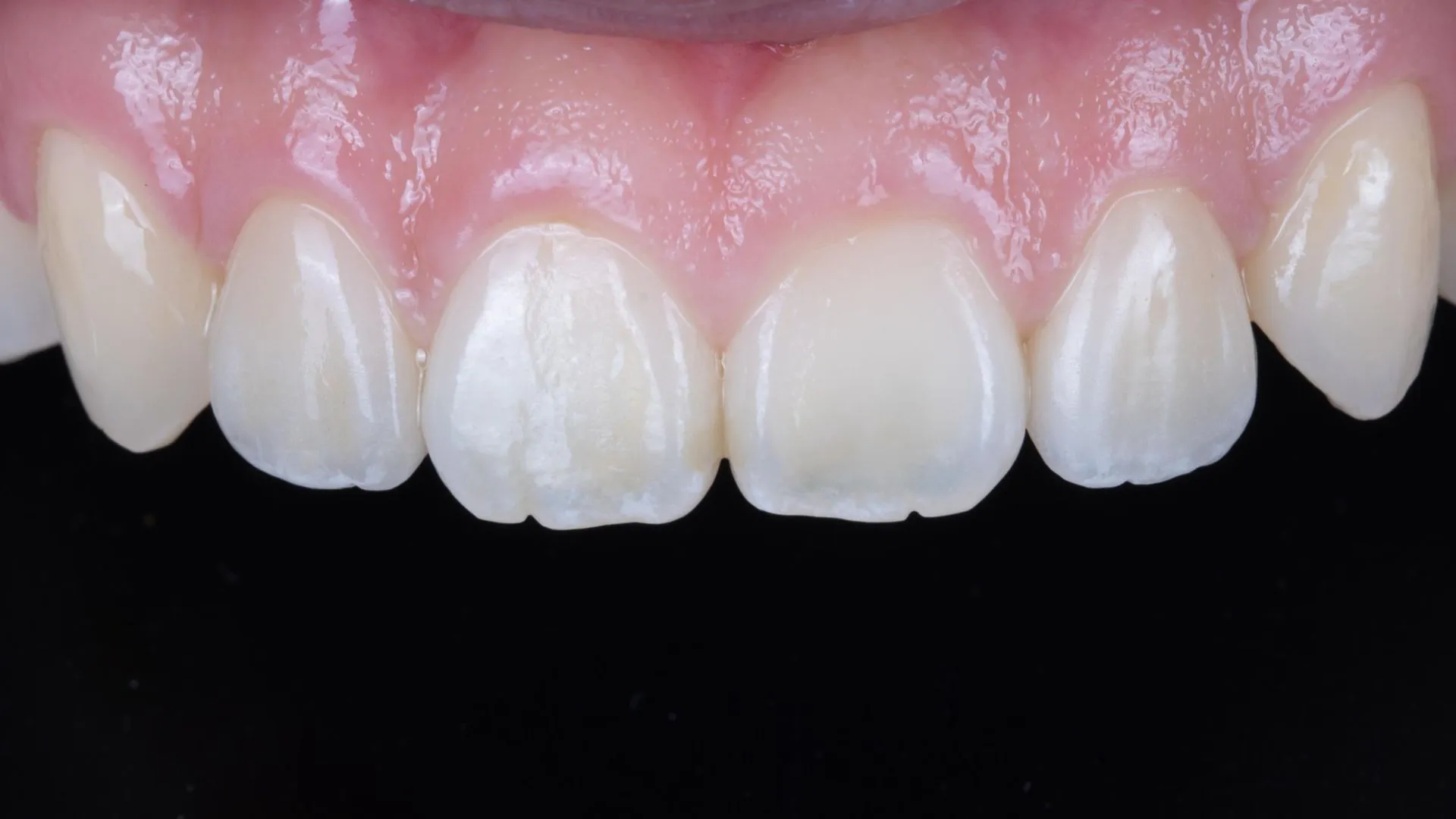 Multilayer build-up veneer result — natural shade and value gradation reproduced