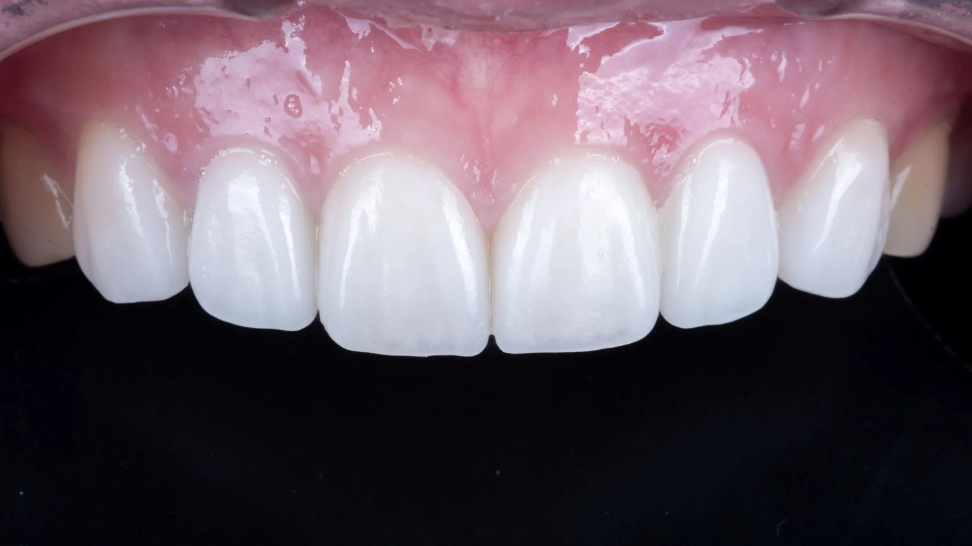 A veneer clinical case at Dream Dental Clinic, Gangnam — handcrafted by Dr. Park Jonguk, twenty years of experience