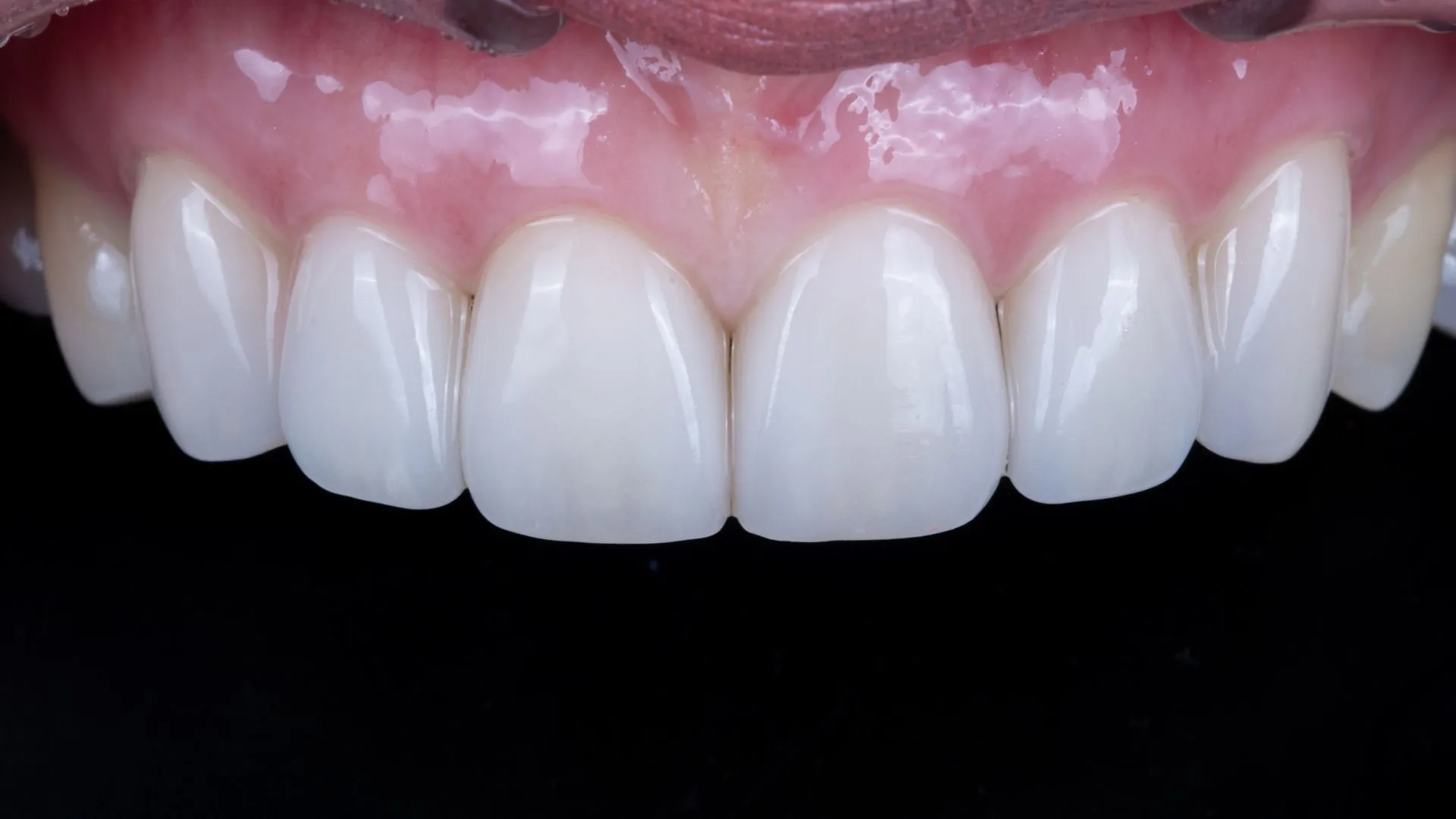 Minimal-reduction veneer result — a clinical case balancing tooth preservation and aesthetics