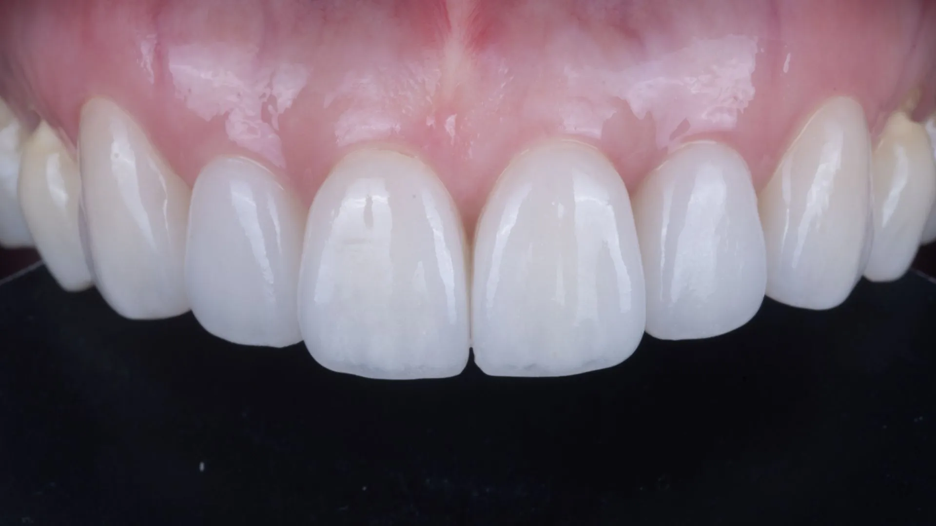 Natural veneer clinical result — shade and translucency designed for each individual patient