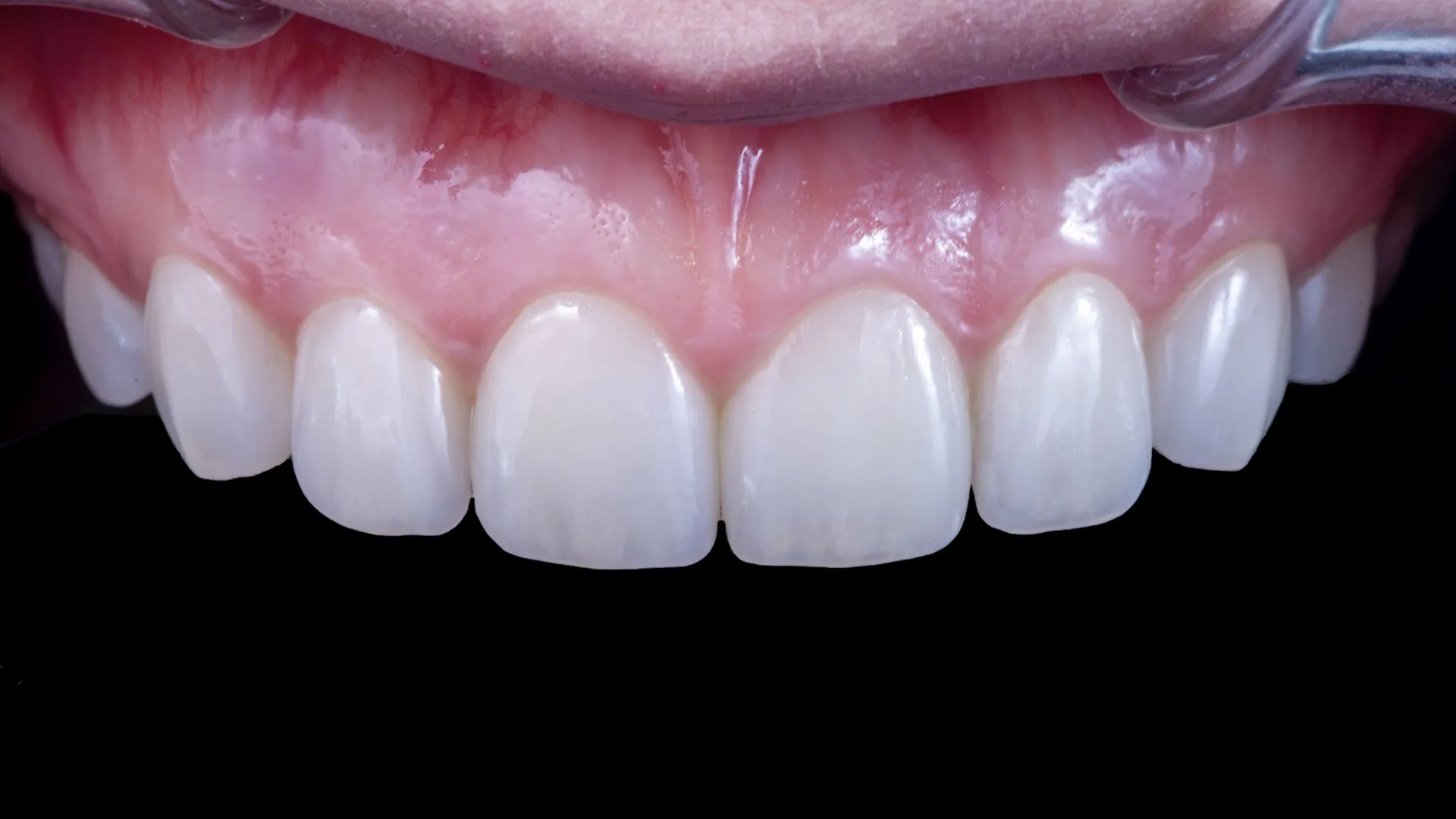 Multilayer build-up veneer result — an aesthetic finish indistinguishable from natural teeth