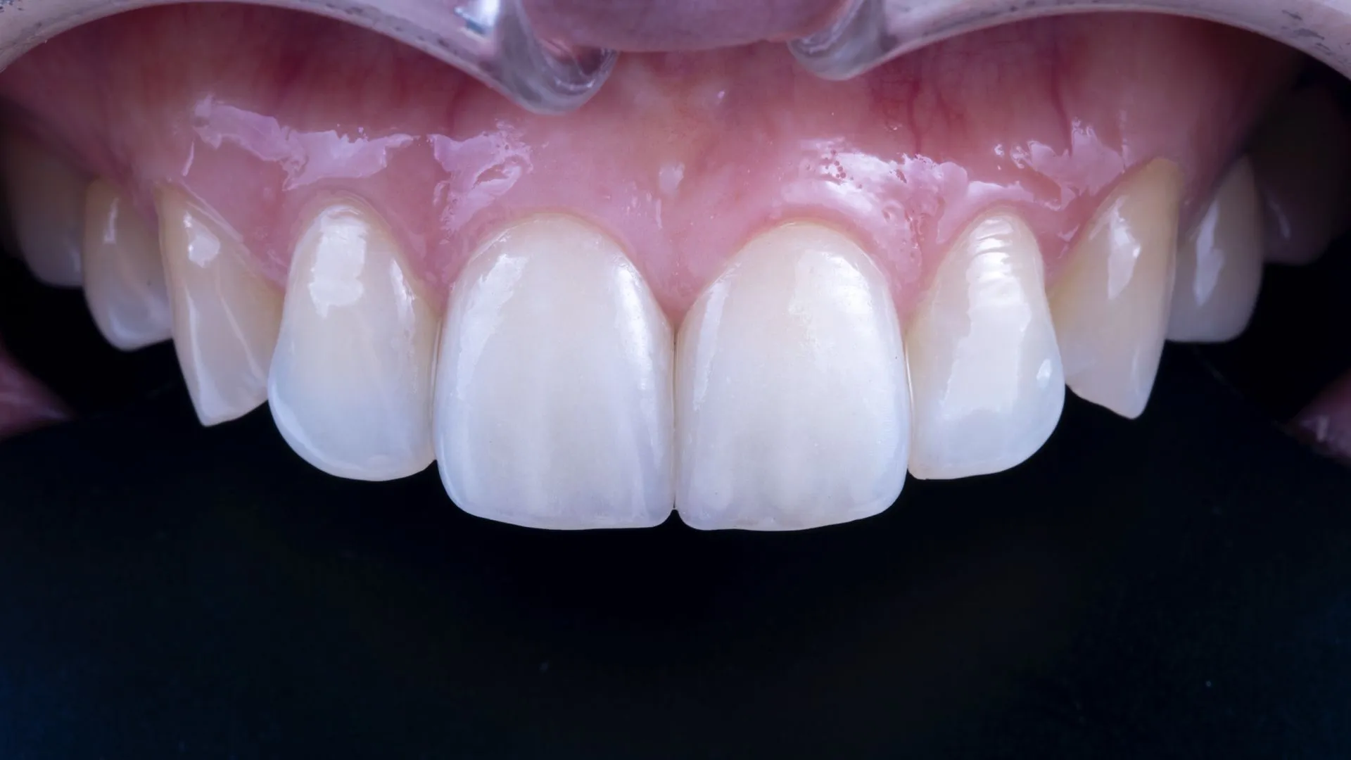 Dr. Park Jonguk’s 20-year veneer clinical case — premium hand-layered ceramic work