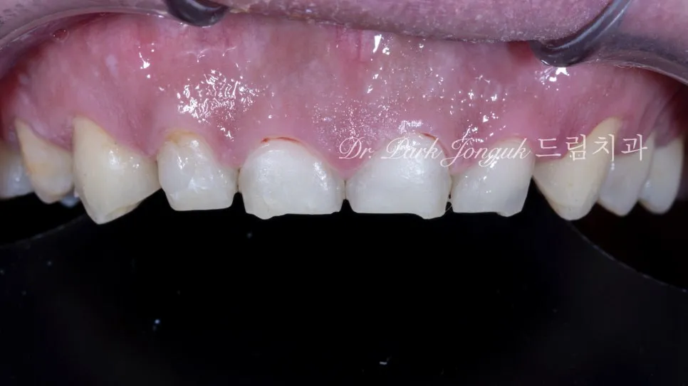 A real clinical case — severely worn, shortened front teeth restored in length and translucency — Before