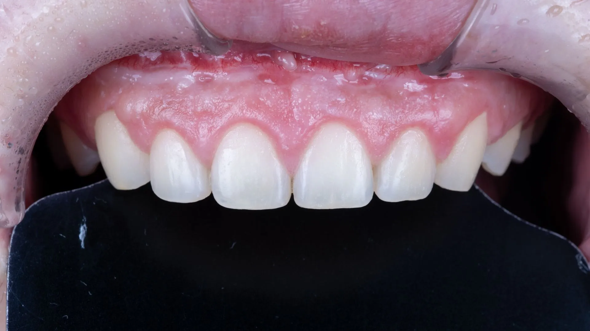 Laser removal and revision — completed