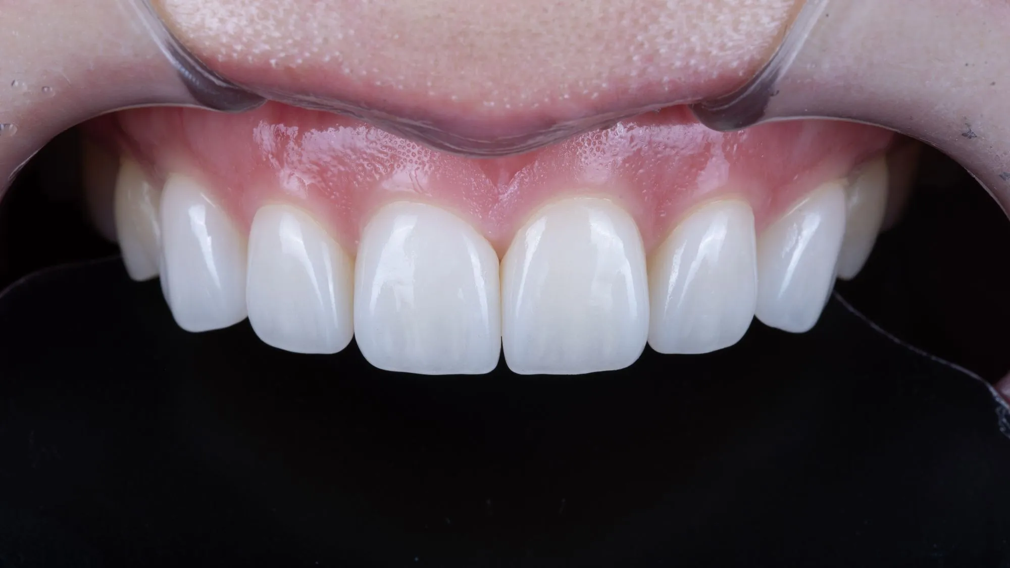 No-prep veneers — frontal view after bonding