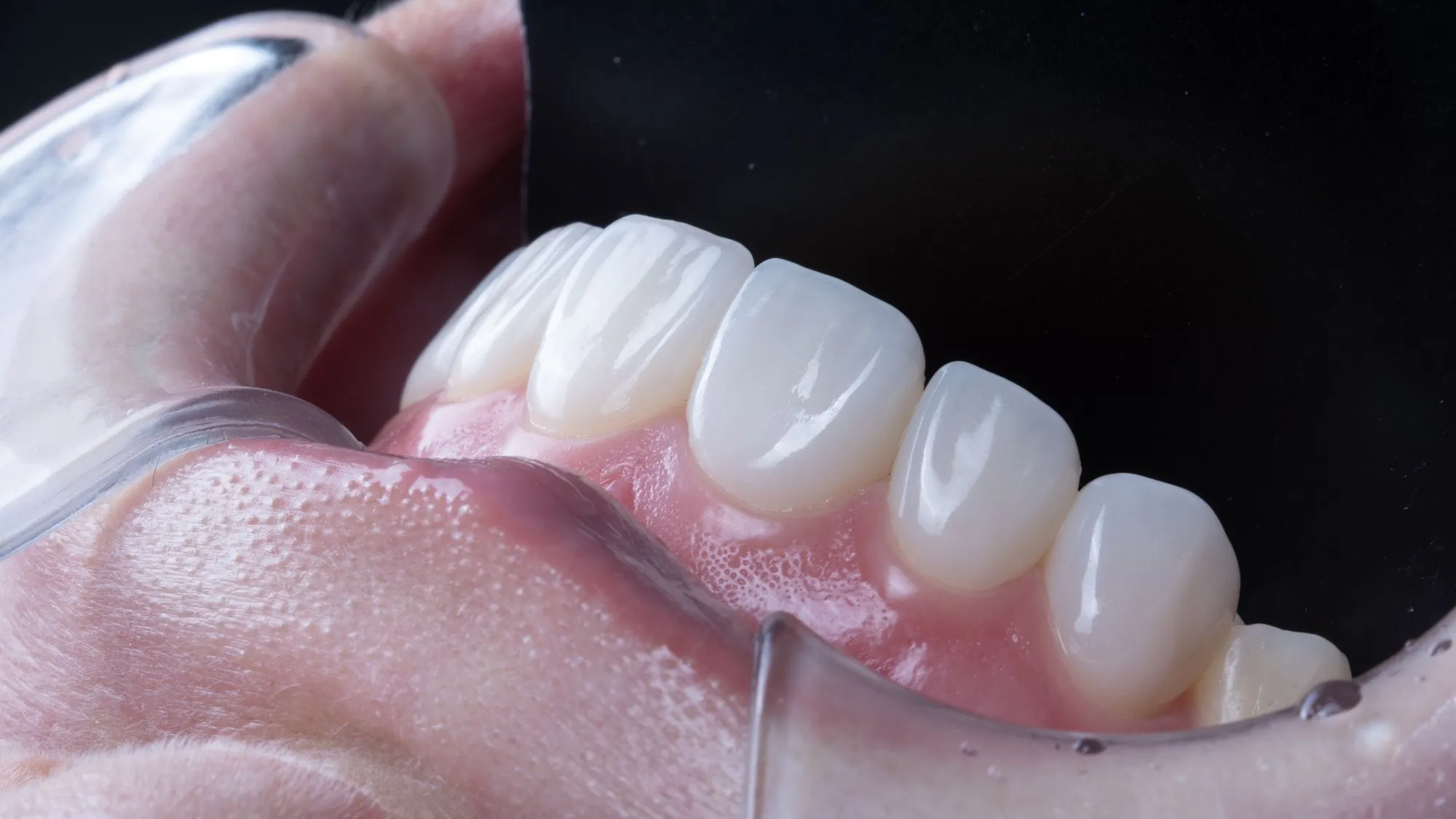 No-prep veneers — completed