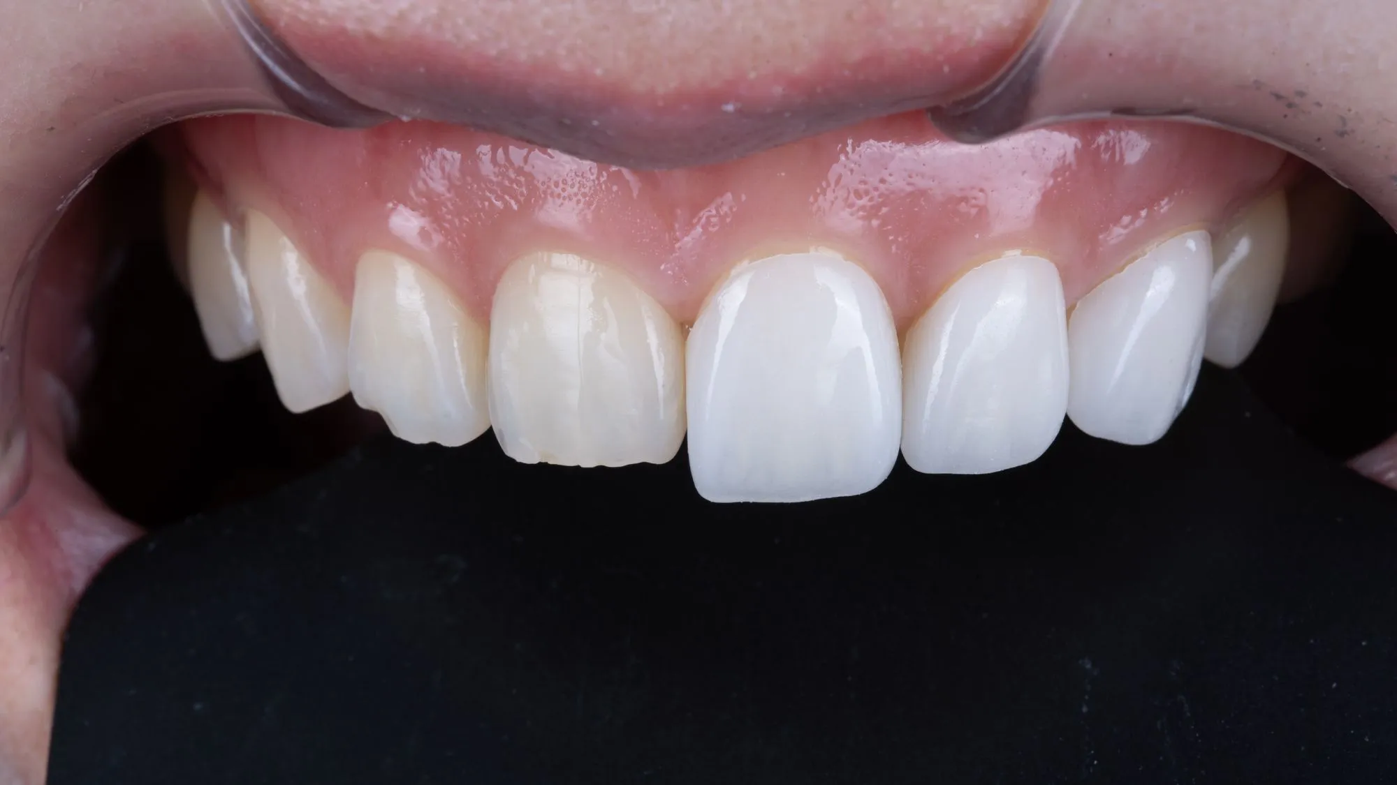 No-prep veneers — at try-in
