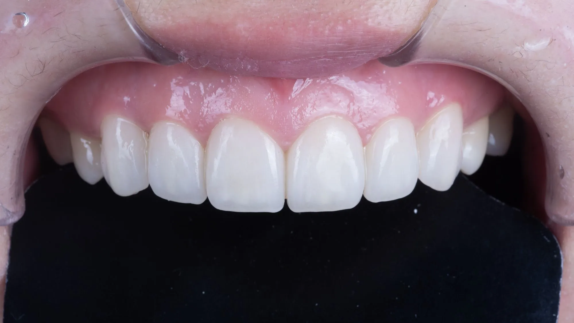 No-prep veneer case 2