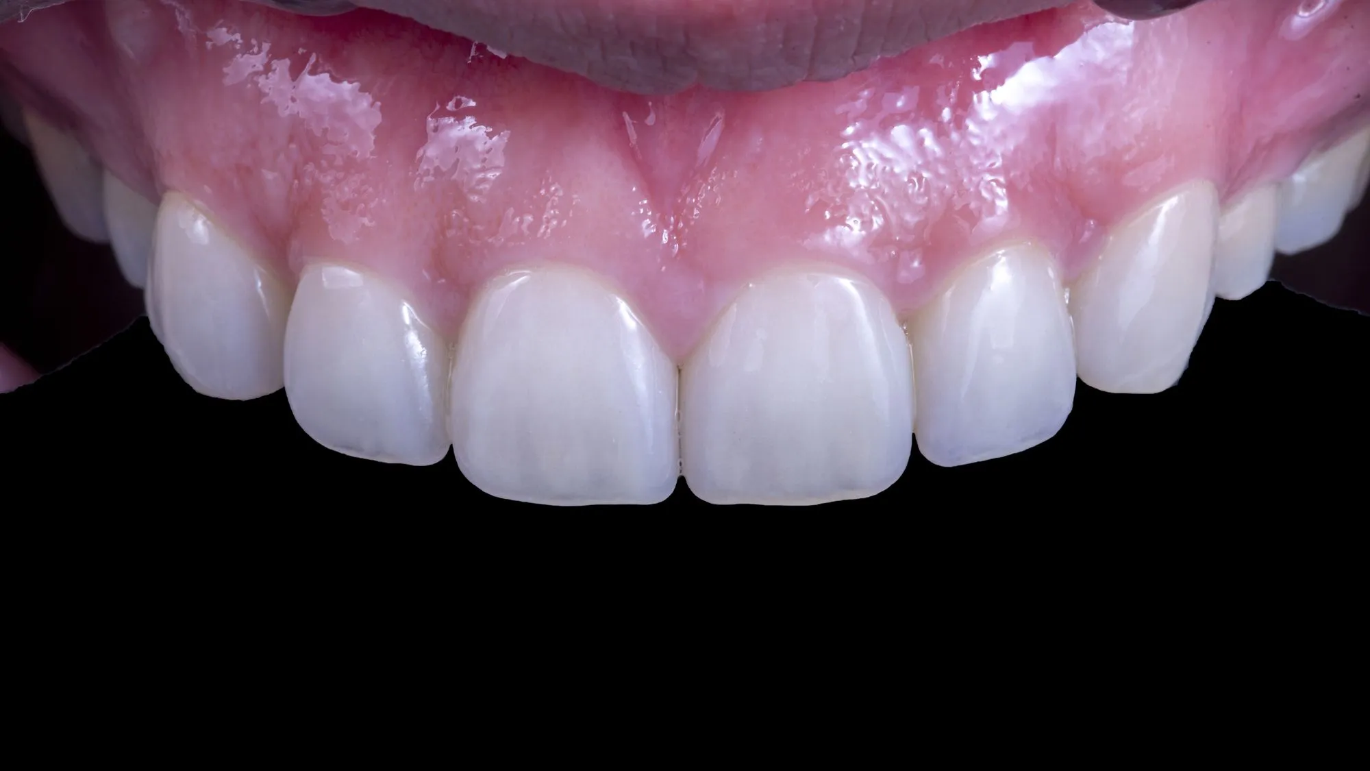 No-prep veneer case 3