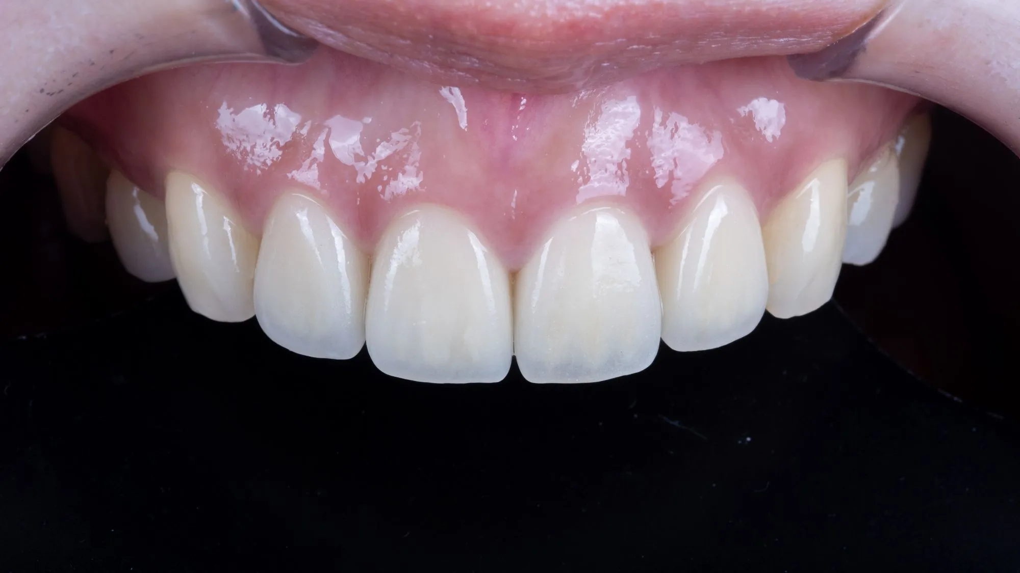 Revision case 1 — AFTER