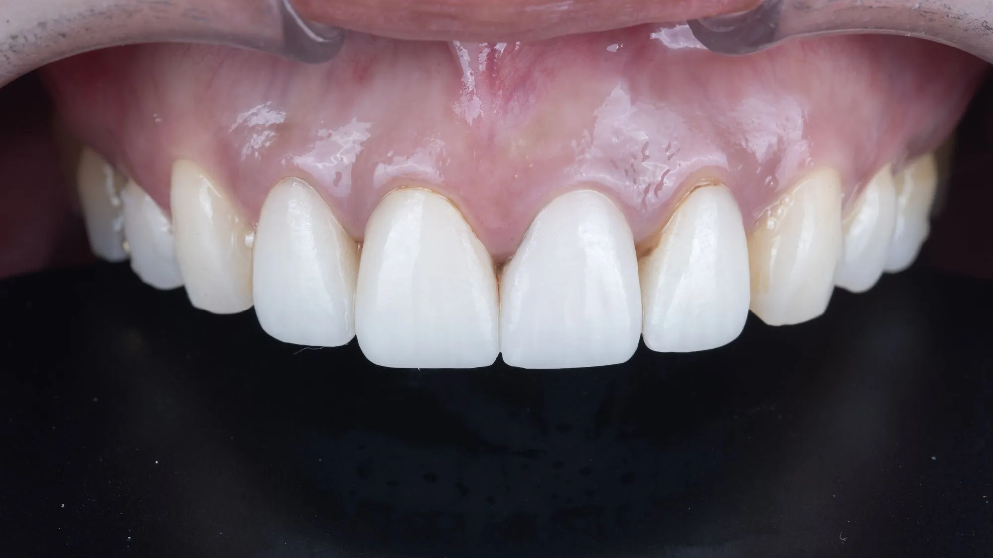 Revision case 1 — BEFORE