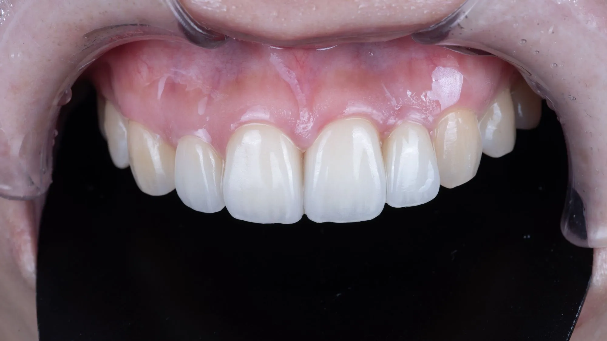 Revision case 2 — AFTER