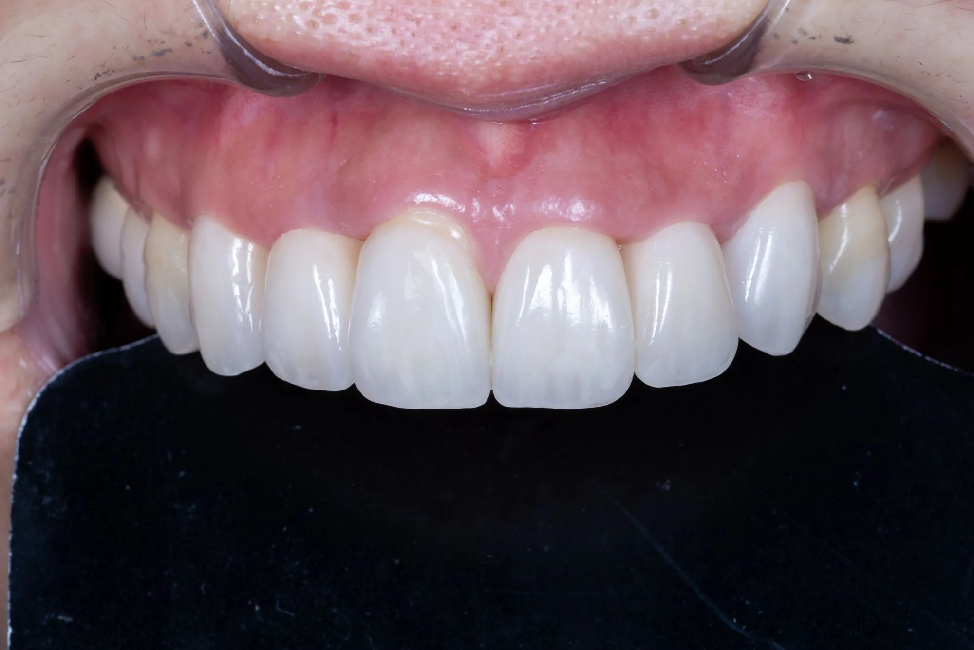 Veneer revision case 3 — after refabrication