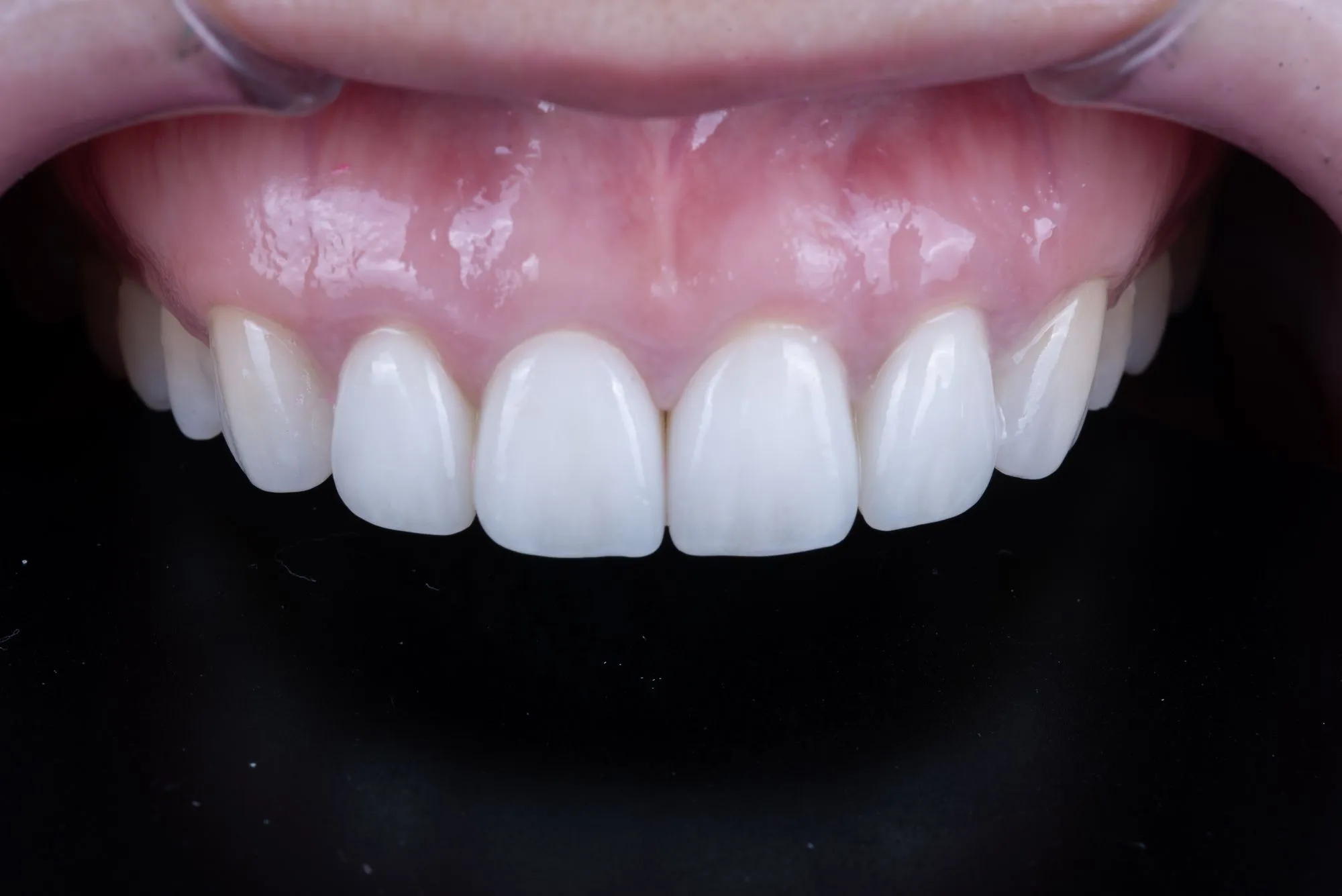 Veneer revision case 4 — after refabrication