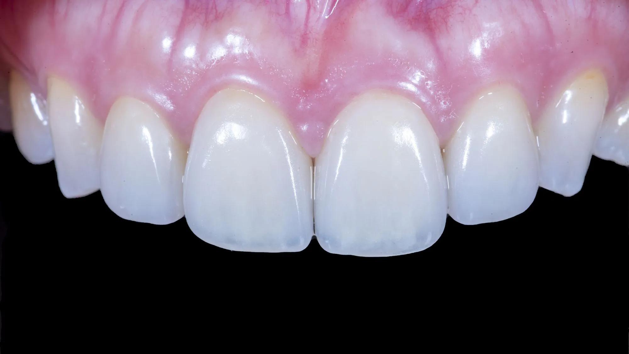 Veneer revision case 5 — after refabrication