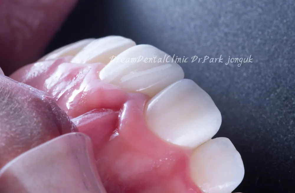 從陶瓷貼片重新治療病例，看副作用與重新治療時的注意事項 — 圖9