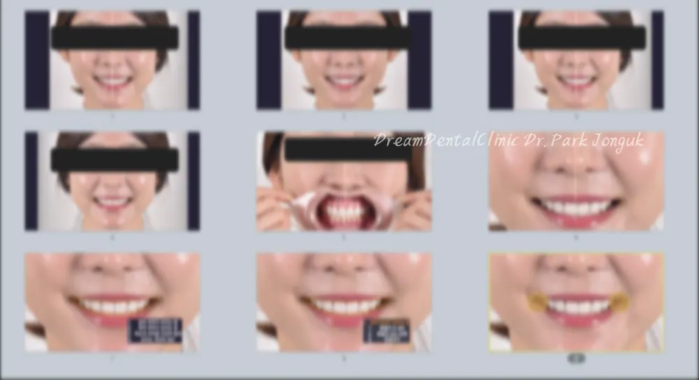라미네이트 치료에서 가장 중요한 점은? 본문 사진 3