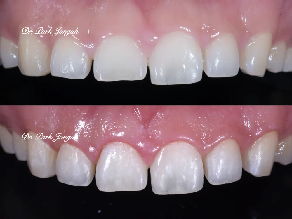 The Know-How Behind Nearly Side-Effect-Free No-Prep Veneers — photo 1