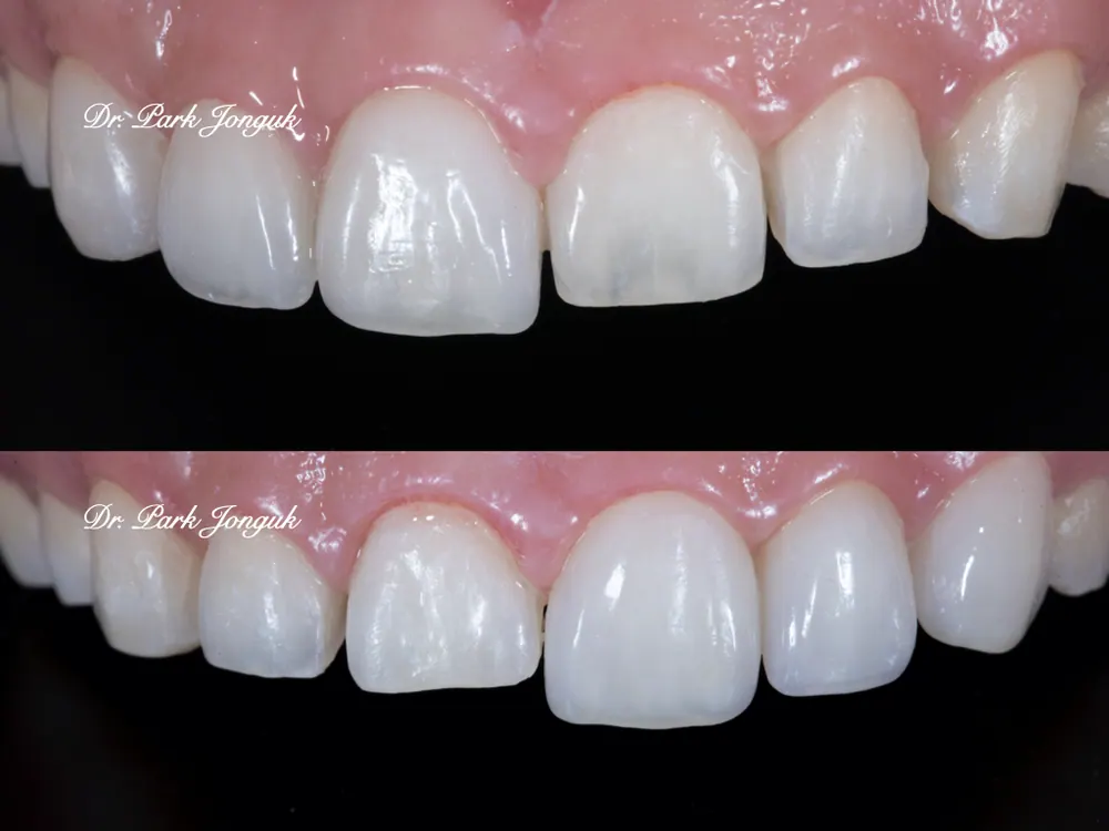 The Know-How Behind Nearly Side-Effect-Free No-Prep Veneers — photo 2
