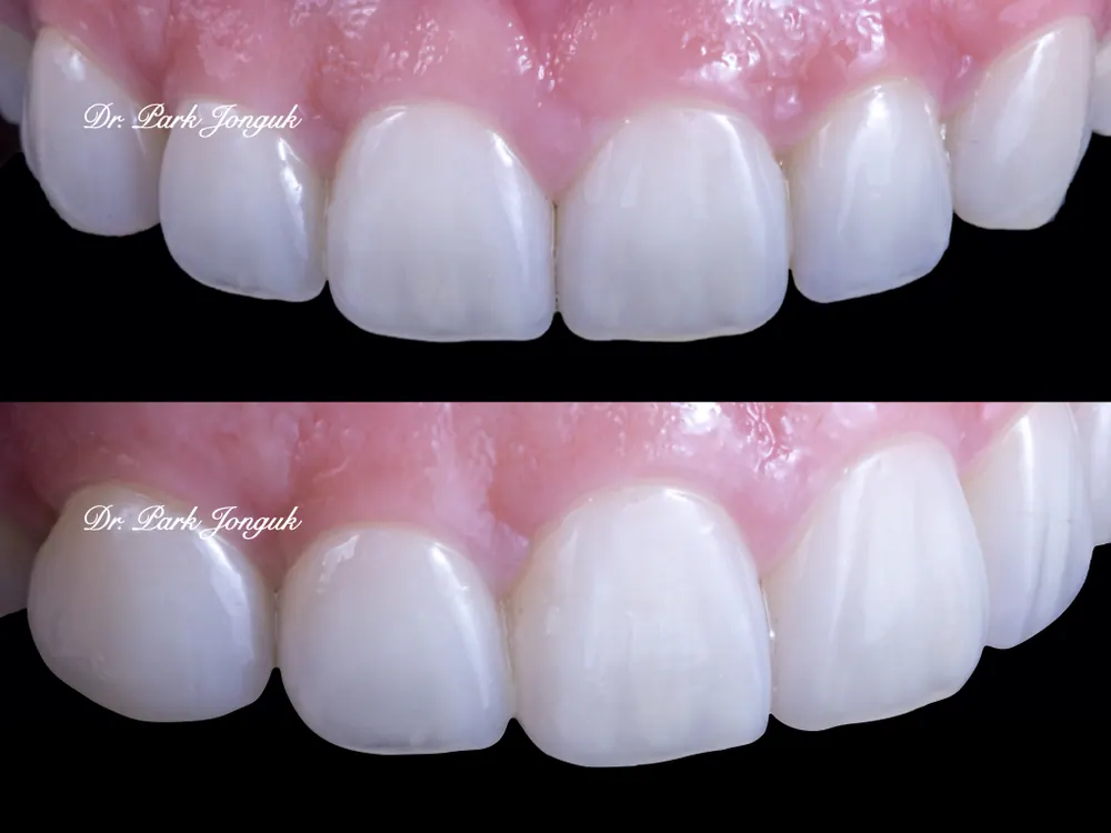 The Know-How Behind Nearly Side-Effect-Free No-Prep Veneers — photo 3
