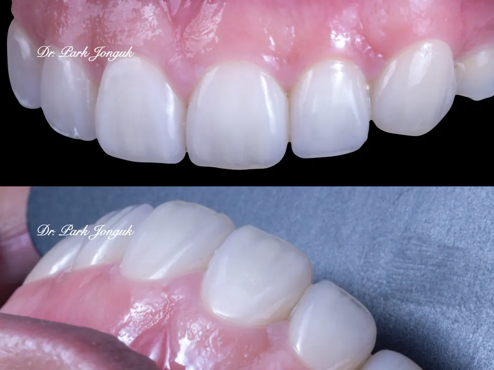 The Know-How Behind Nearly Side-Effect-Free No-Prep Veneers — photo 4