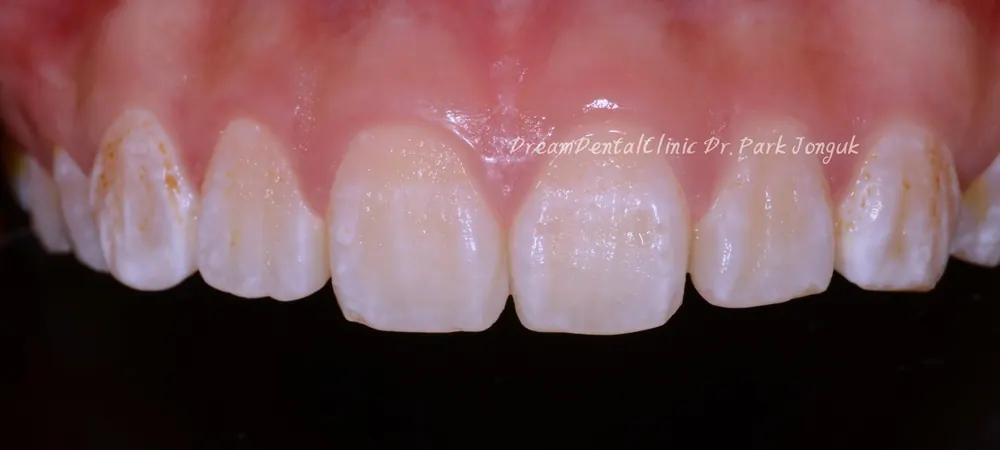 The Know-How Behind Nearly Side-Effect-Free No-Prep Veneers — photo 5