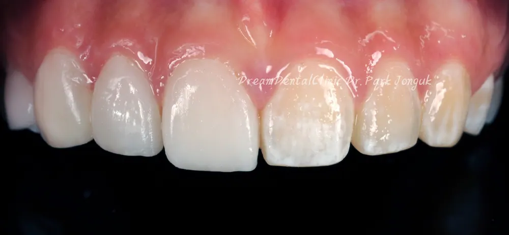 The Know-How Behind Nearly Side-Effect-Free No-Prep Veneers — photo 6