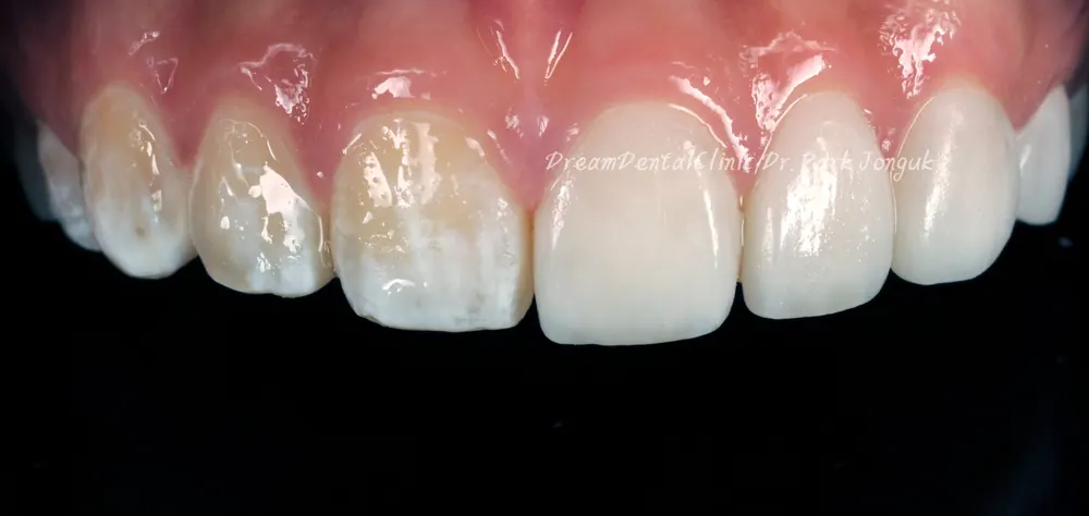 The Know-How Behind Nearly Side-Effect-Free No-Prep Veneers — photo 7