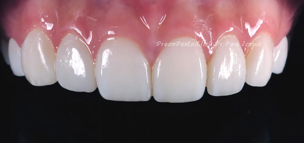 The Know-How Behind Nearly Side-Effect-Free No-Prep Veneers — photo 8