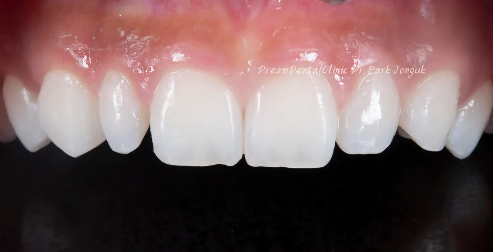 The Know-How Behind Nearly Side-Effect-Free No-Prep Veneers — photo 9
