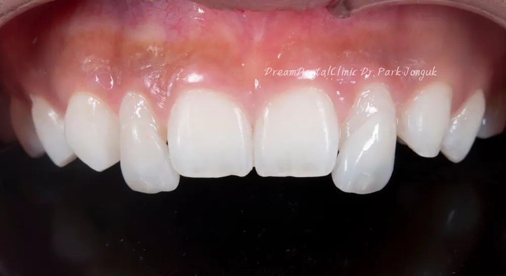 The Know-How Behind Nearly Side-Effect-Free No-Prep Veneers — photo 10