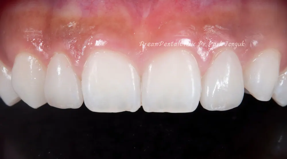 The Know-How Behind Nearly Side-Effect-Free No-Prep Veneers — photo 11