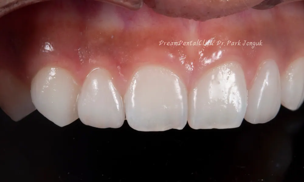 The Know-How Behind Nearly Side-Effect-Free No-Prep Veneers — photo 12