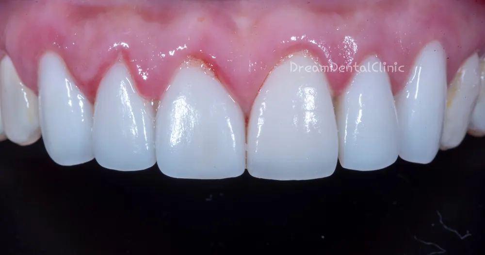 Làm lại Veneer do viêm nướu vì mài răng quá mức — ảnh 1