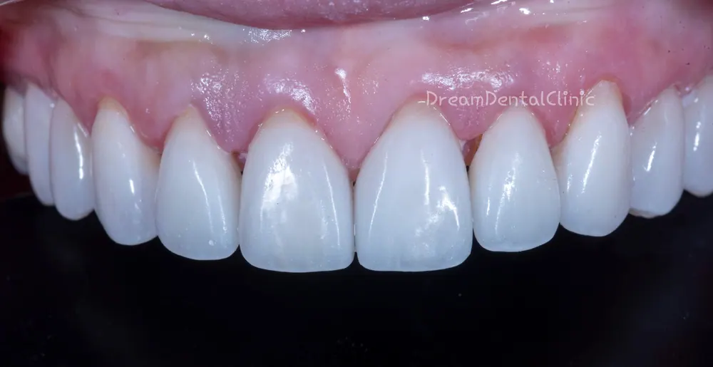 Làm lại Veneer do viêm nướu vì mài răng quá mức — ảnh 2