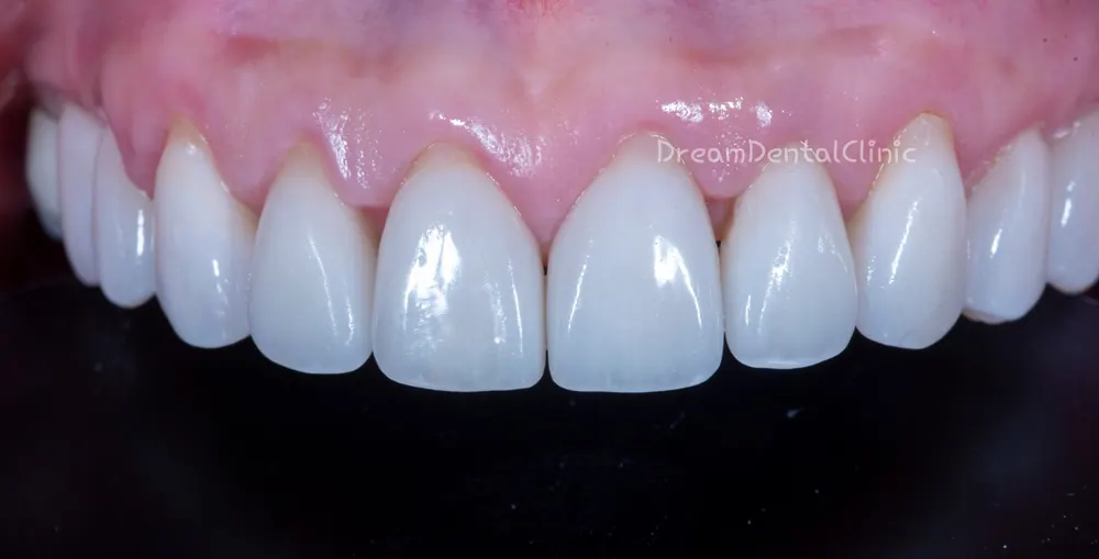 Làm lại Veneer do viêm nướu vì mài răng quá mức — ảnh 3