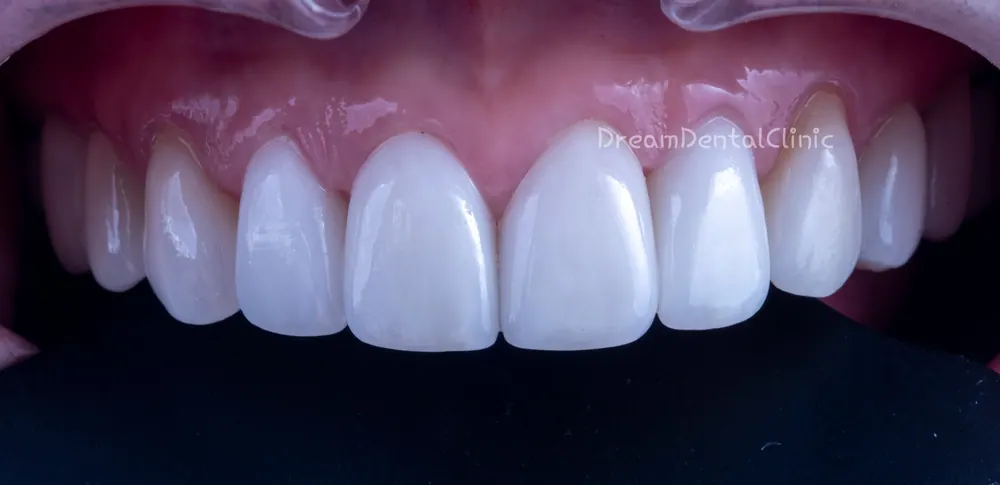 Làm lại Veneer do viêm nướu vì mài răng quá mức — ảnh 4